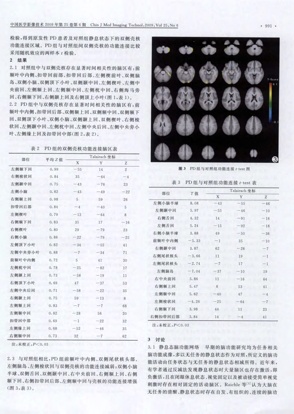 功能磁共振成像评价帕金森患者静息状态下脑功能连接_第3页