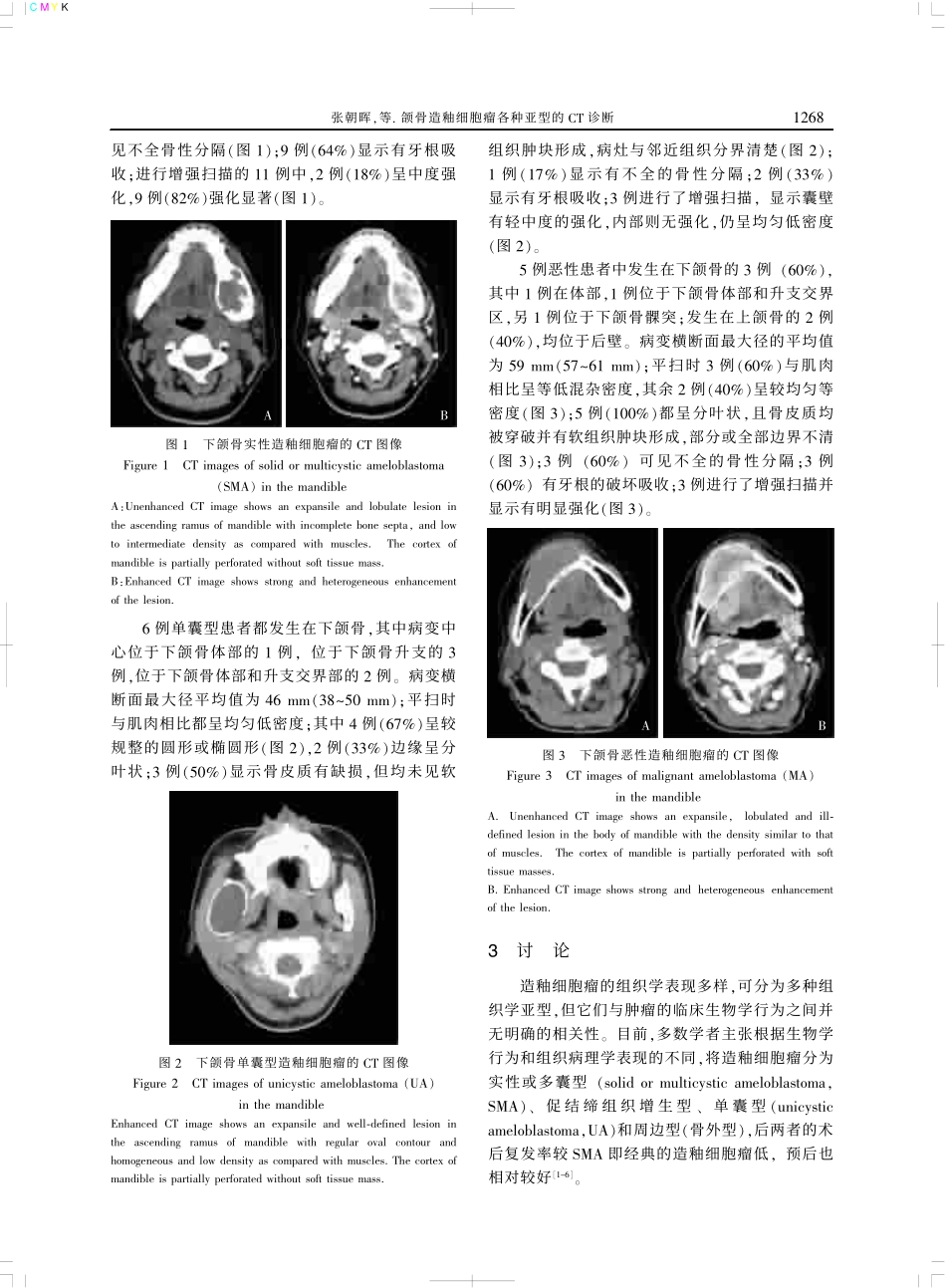 颌骨造釉细胞瘤各种亚型的_第3页