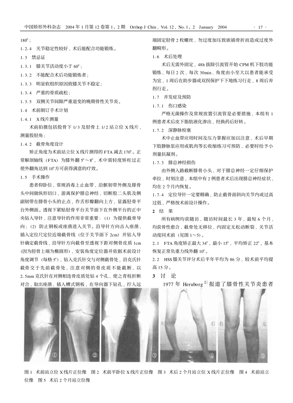 胫骨高位截骨Link槽式钢板内固定治疗膝关节骨性关节炎并膝内翻_第2页