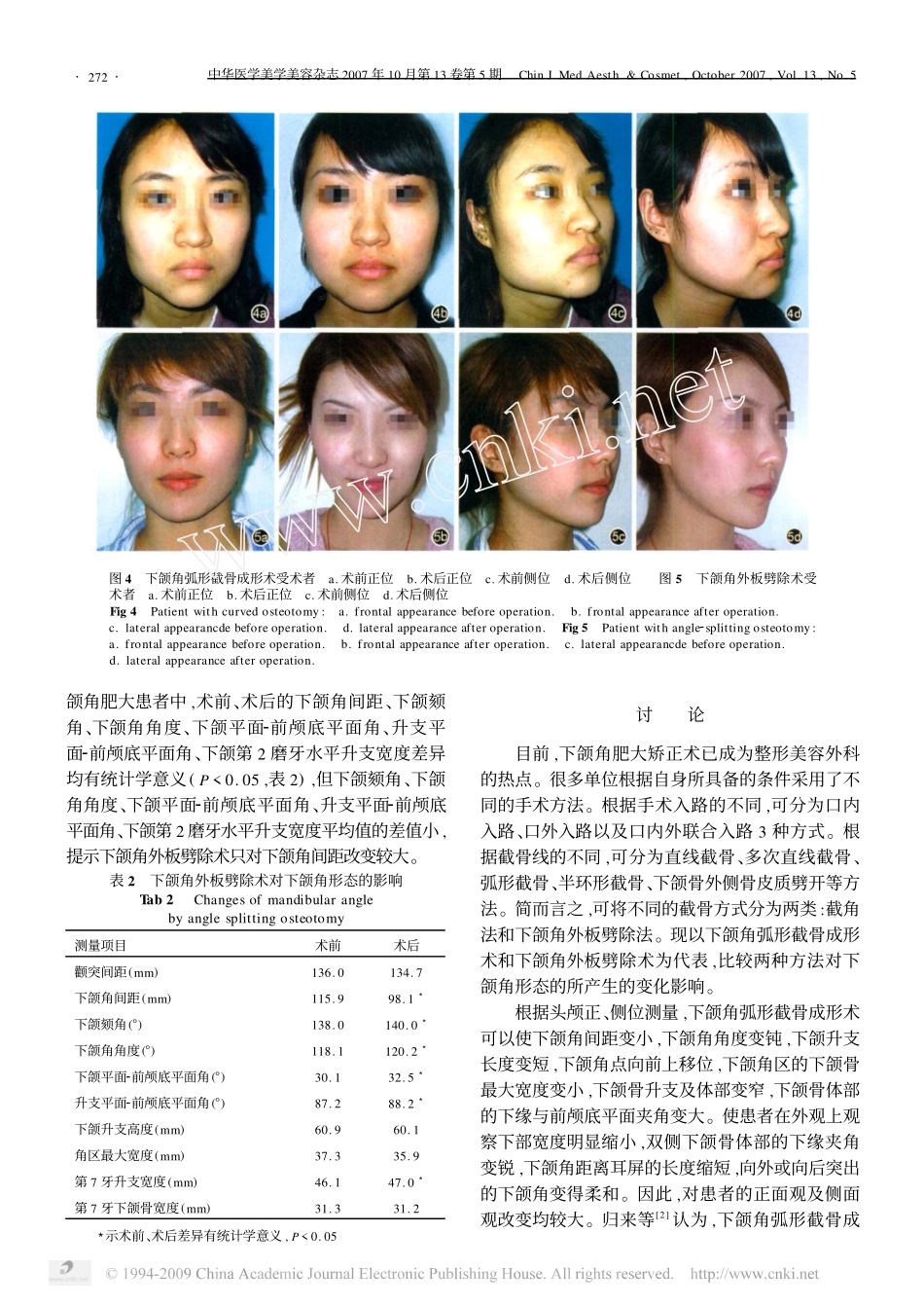 弧形截骨术和外板劈除术对下颌角形态变化的比较_第3页