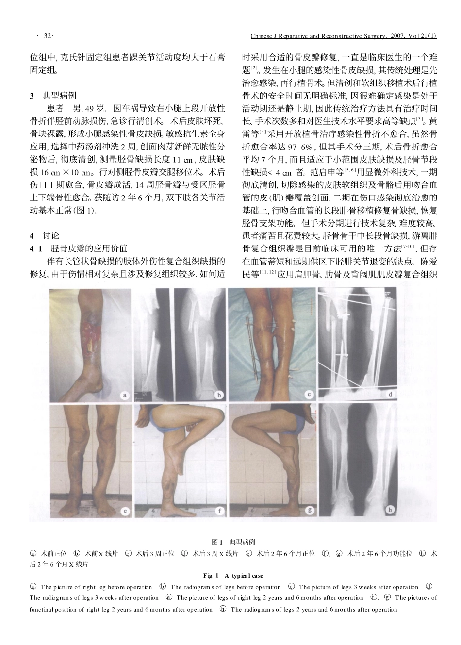 胫骨皮瓣修复小腿感染性骨皮缺损的应用_第3页