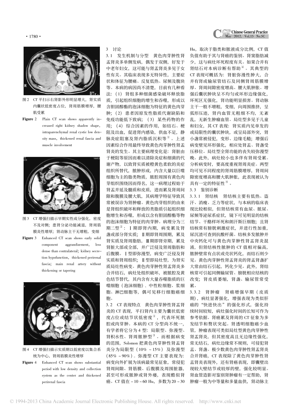 黄色肉芽肿性肾盂肾炎的CT影像诊断与鉴别诊断_第2页
