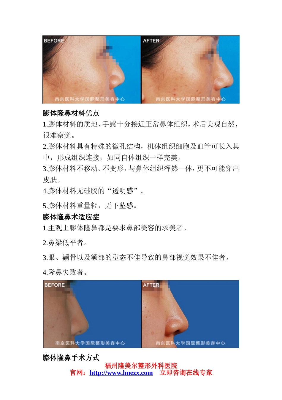 福建膨体隆鼻费用是多少_第2页