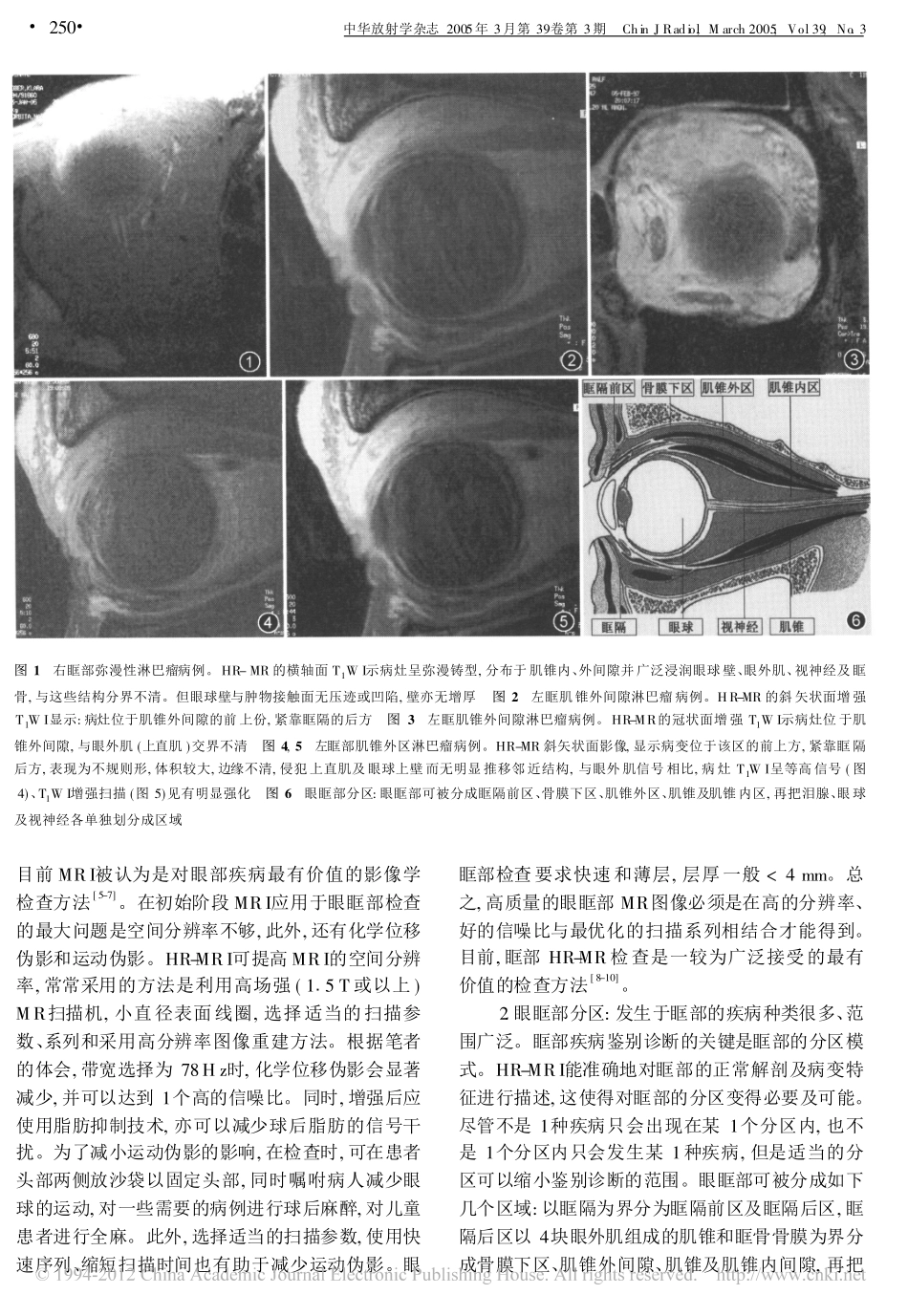 眶部肌锥外间隙非霍奇金淋巴瘤的高分辨率MRI表现_第3页