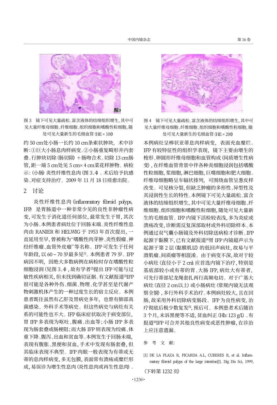回肠末端炎性纤维性息肉伴下_第2页