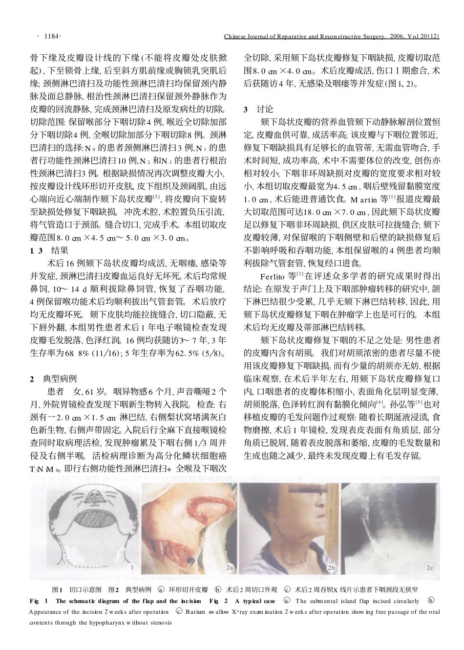 颏下岛状皮瓣一期修复下咽肿瘤切除后非环周缺损_第2页