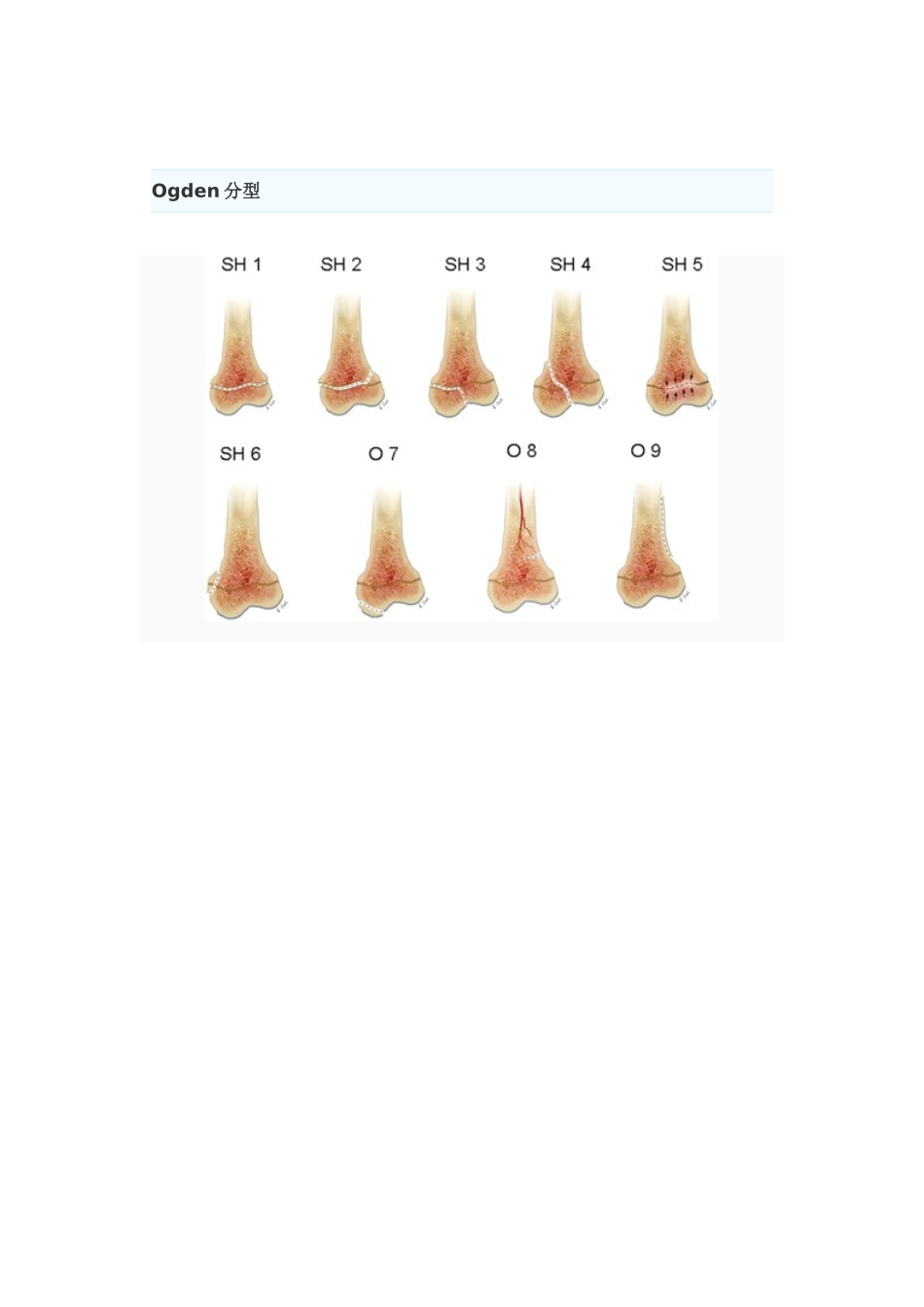 骨骺损伤的分型_第3页