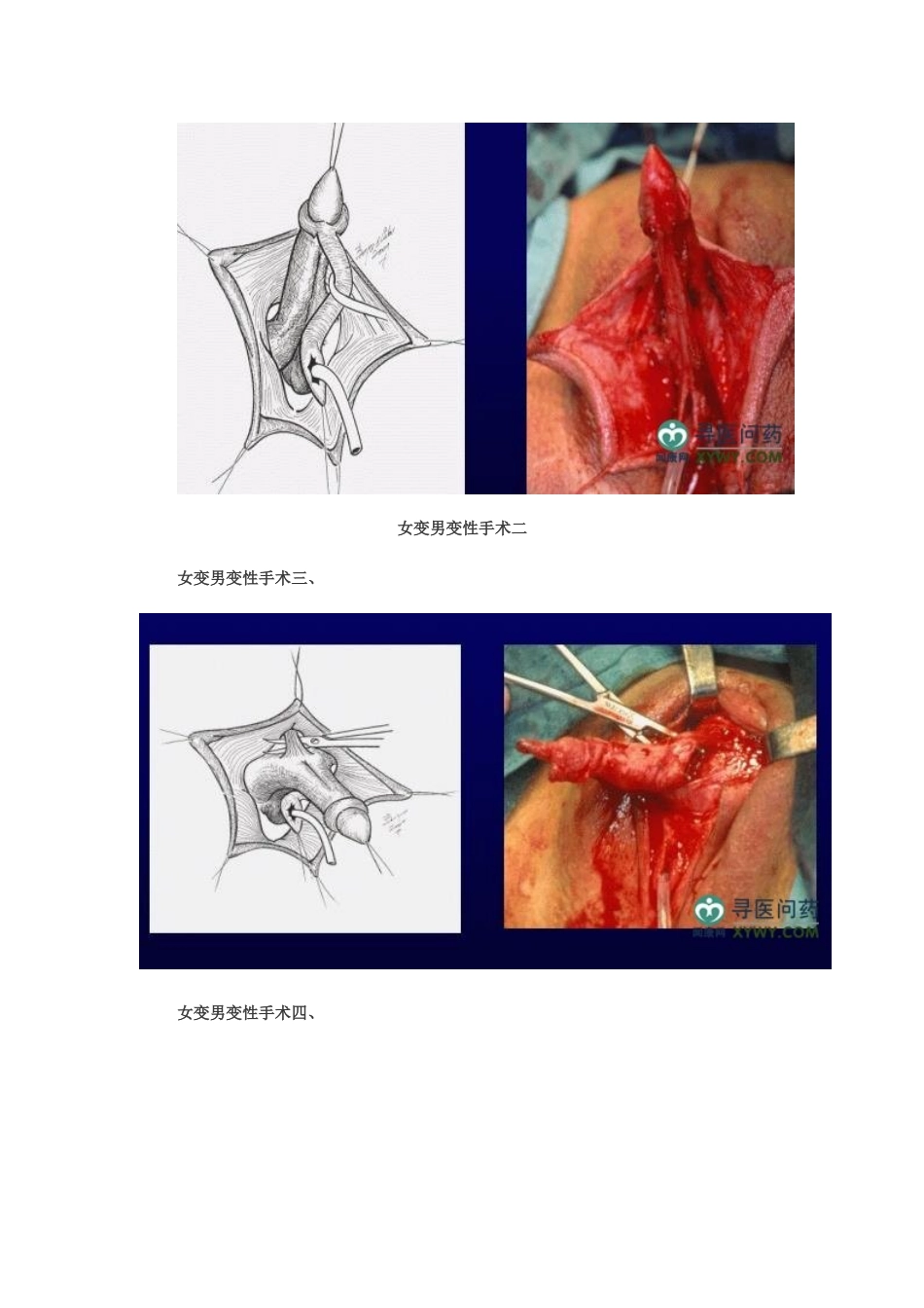 女变男变性手术_第2页