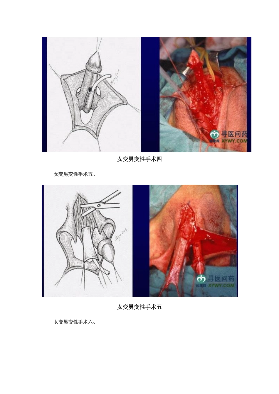 女变男变性手术_第3页