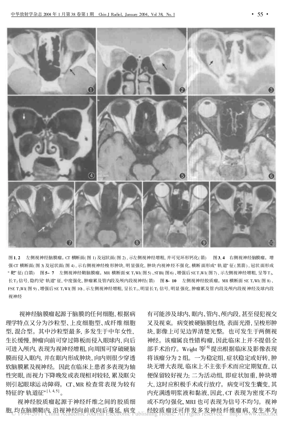 视神经肿瘤的CTMRI诊断_第3页