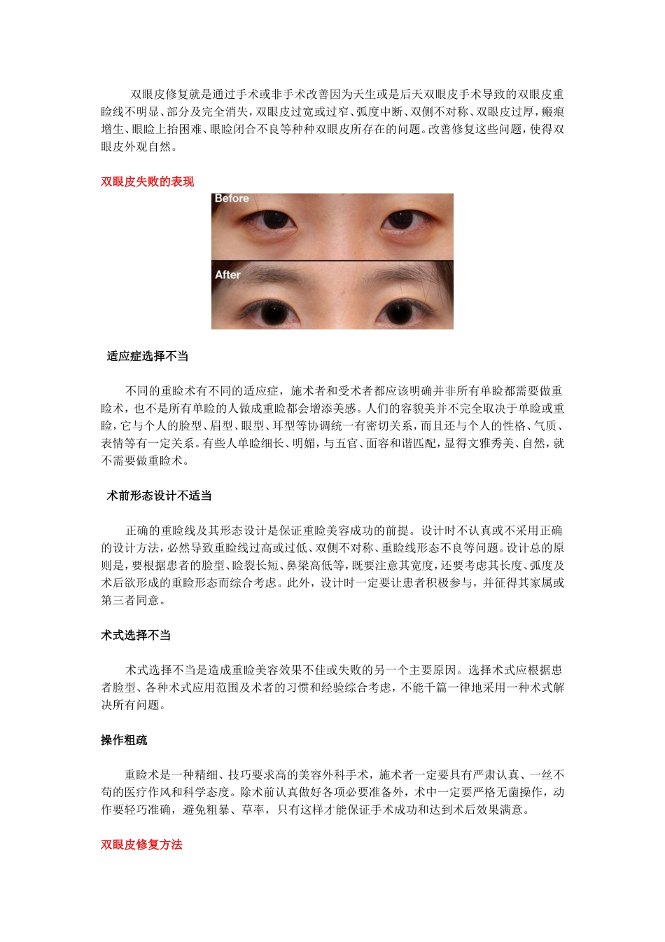 失败双眼皮修复分析_第1页