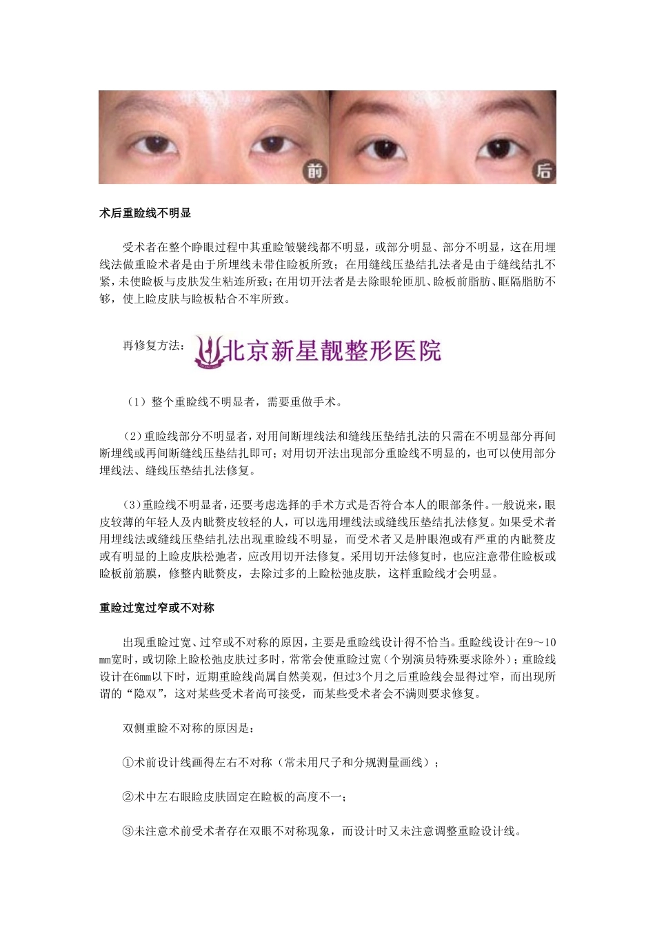 失败双眼皮修复分析_第2页