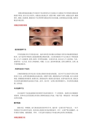 失败双眼皮修复分析