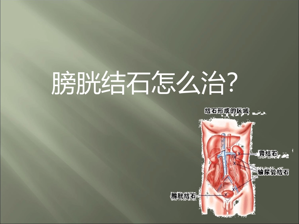 膀胱结石怎么治_第1页