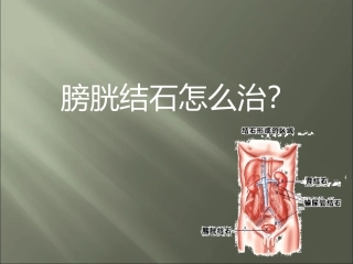 膀胱结石怎么治