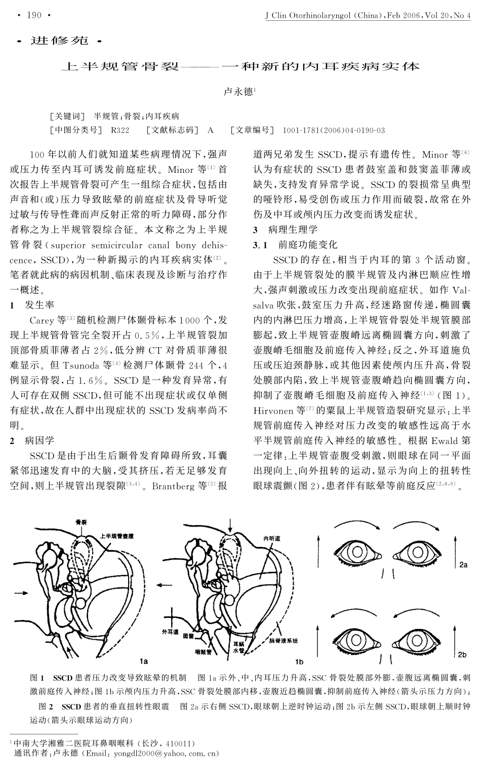 上半规管骨裂--一种新的内耳疾病实体卢永德1_第1页