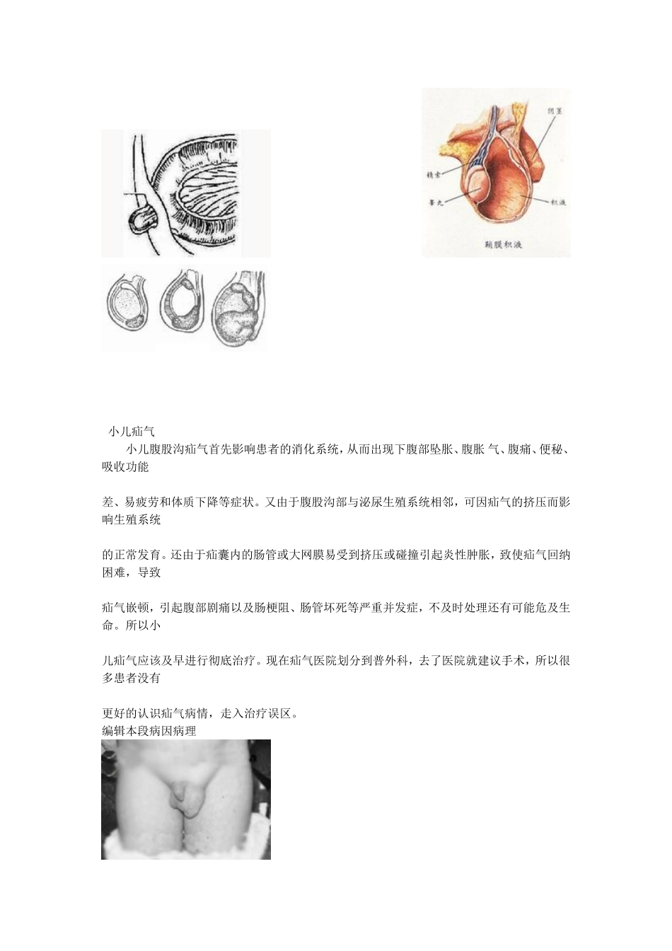疝气(鞘膜积液)症状及验方_第2页