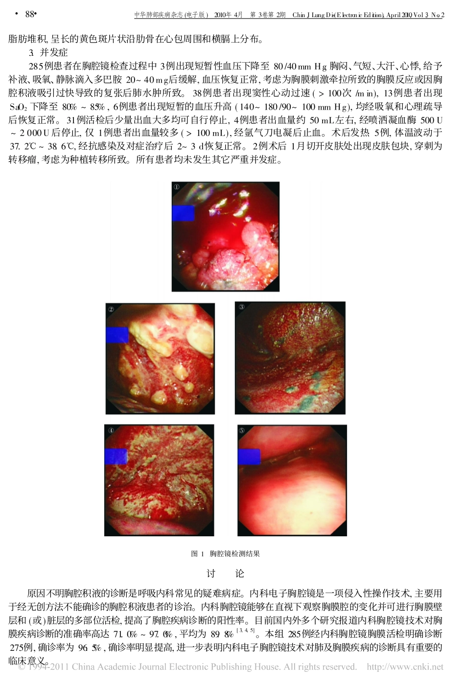 内科胸腔镜在原因不明胸腔积液诊断中的价值及安全性评价_金发光_第3页