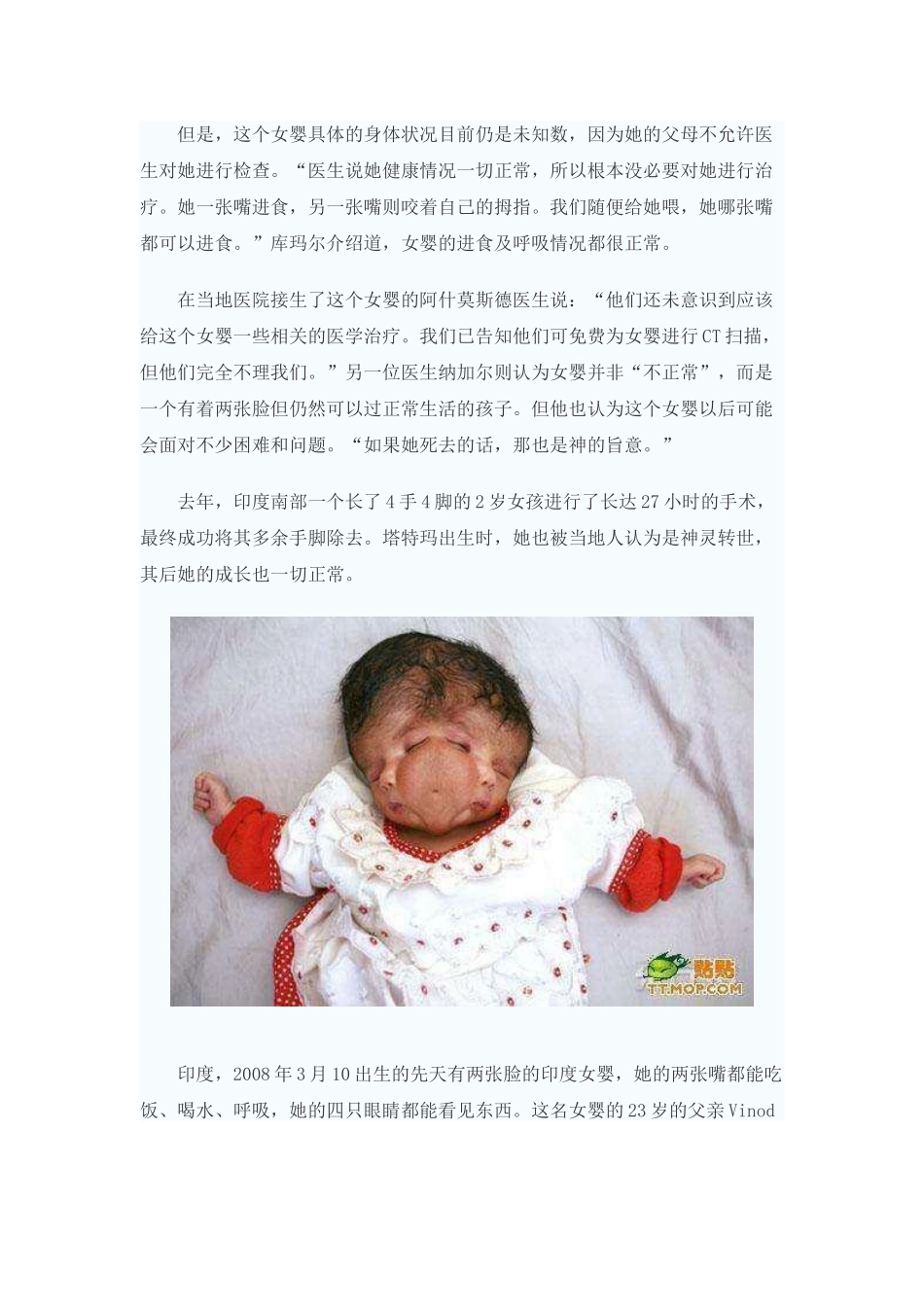 全球十大畸形人盘点_第2页