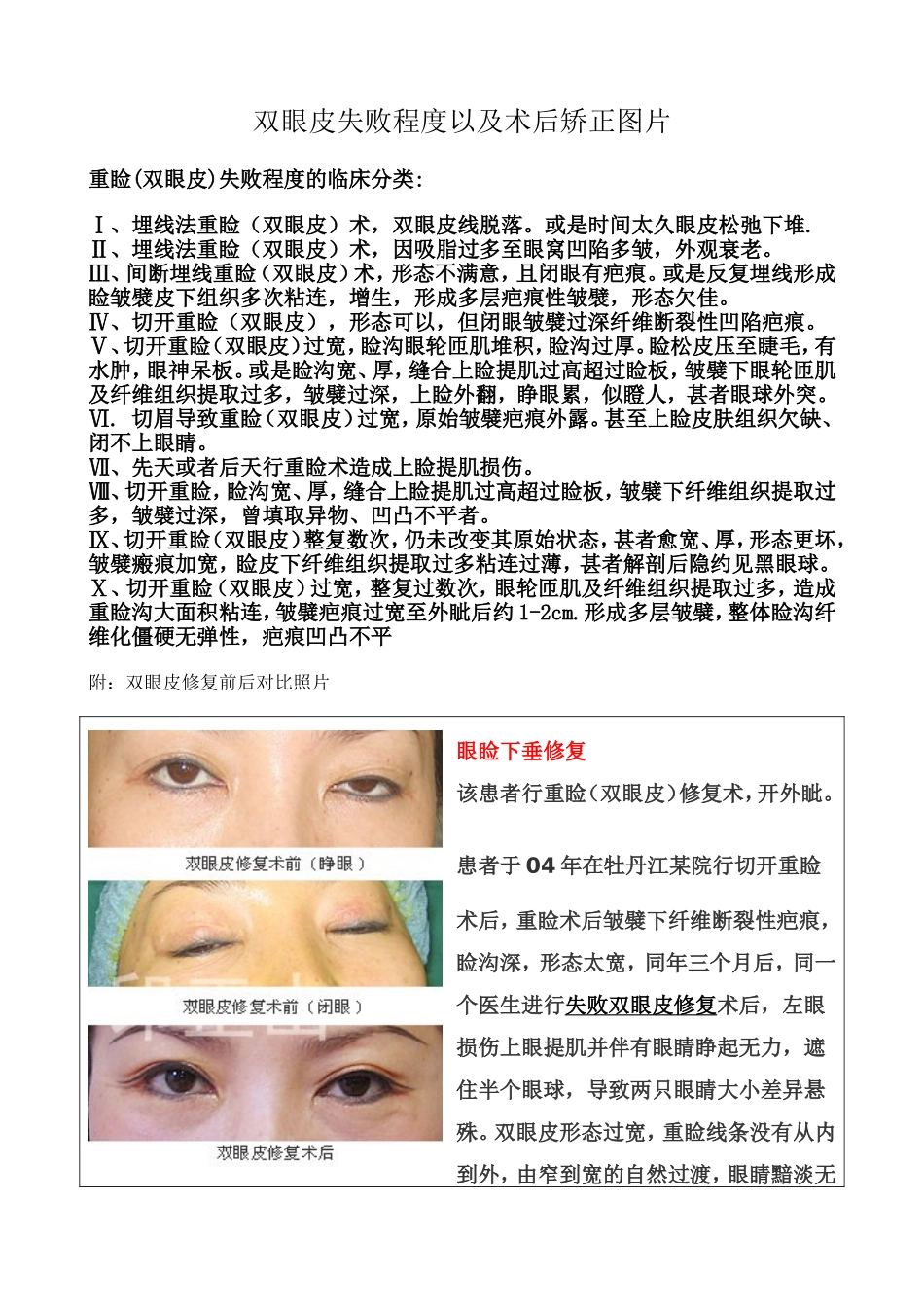 双眼皮失败程度以及术后矫正图片_第1页