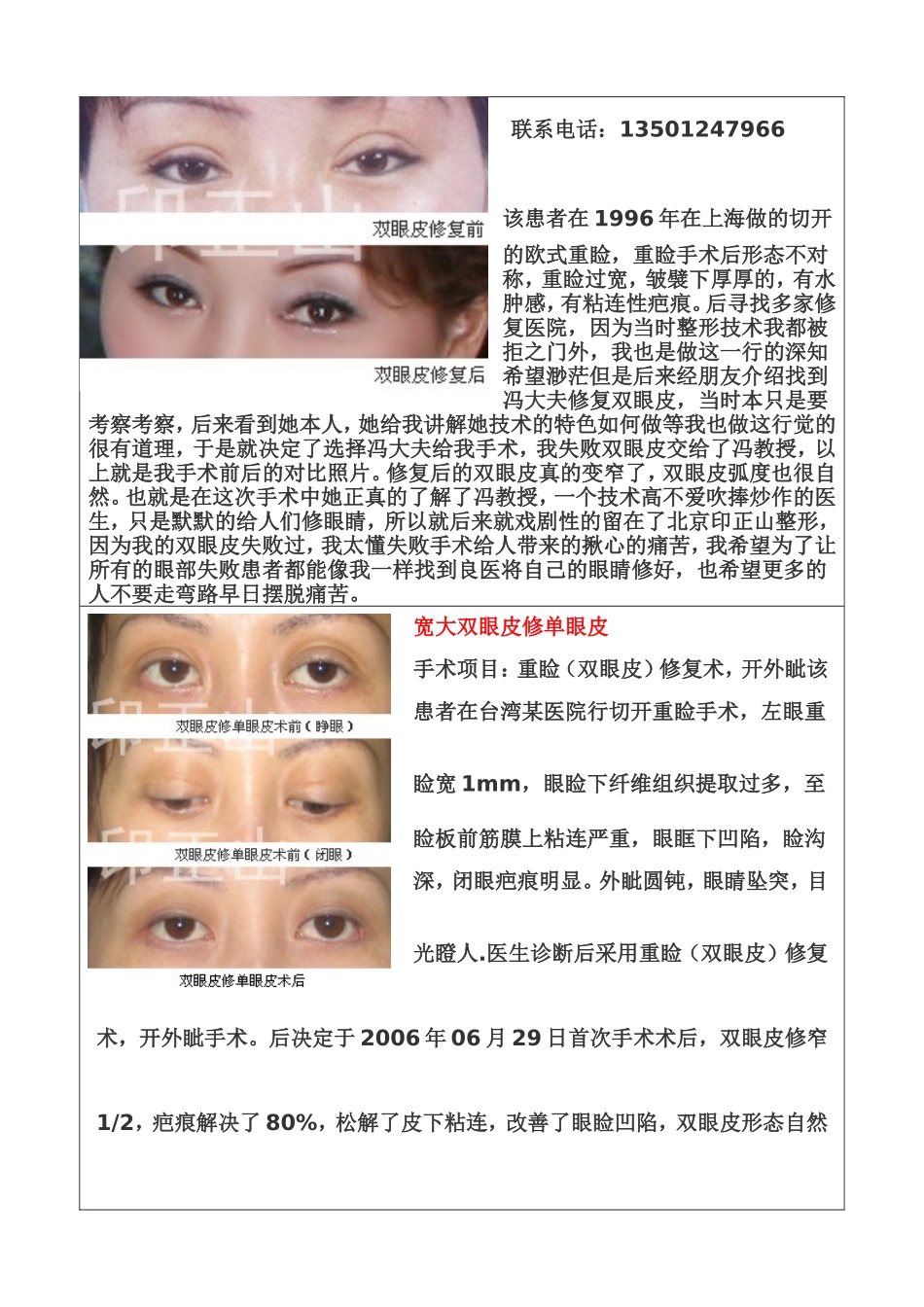 双眼皮失败程度以及术后矫正图片_第3页