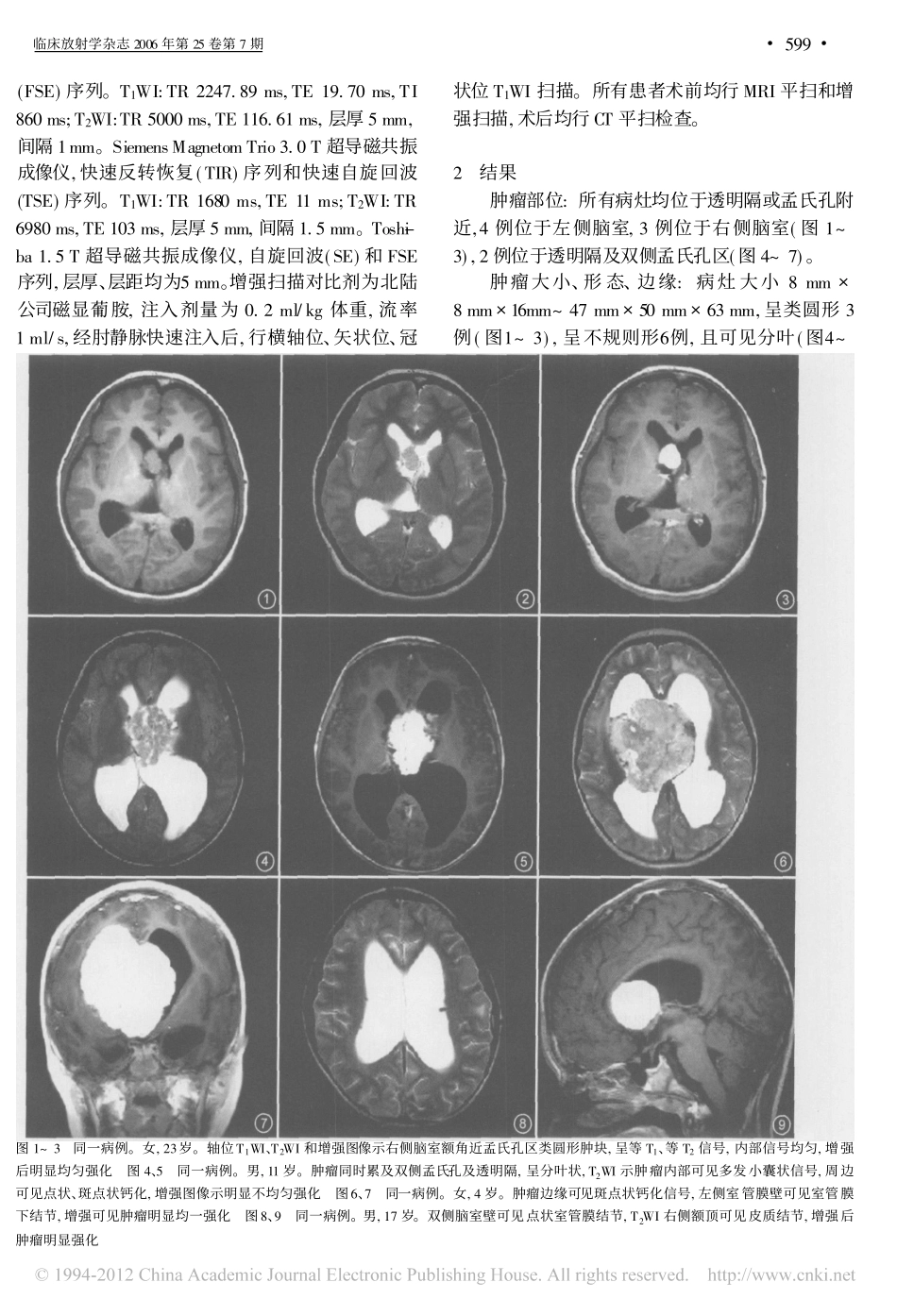 室管膜下巨细胞星形细胞瘤的MRI诊断_第2页