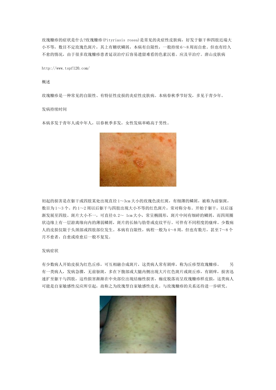 玫瑰糠疹的症状是什么_第1页