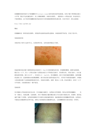 玫瑰糠疹的症状是什么
