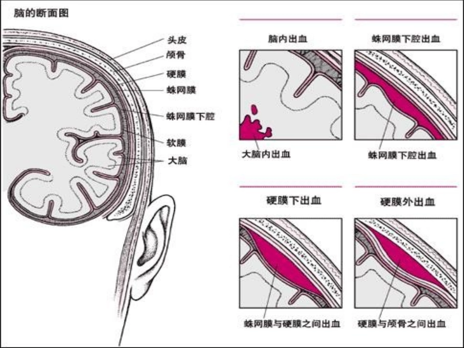 神经外科各种引流管的观察及护理_第3页