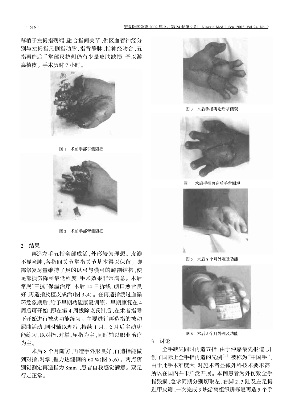 全手指缺损急诊足趾游离移植再造五指的体会_第2页