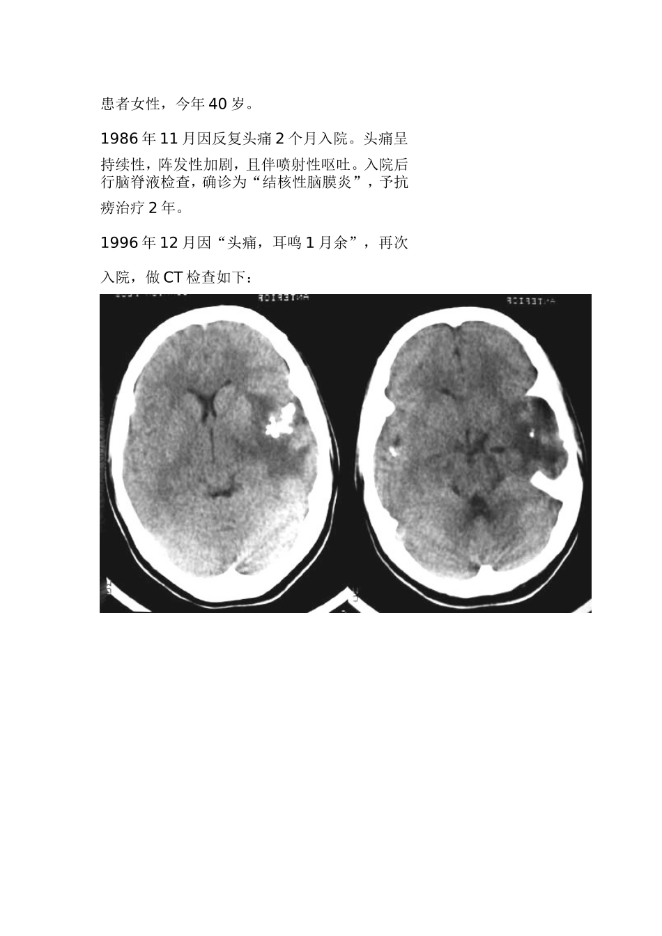 颅内嗜酸性肉芽肿一例_第1页