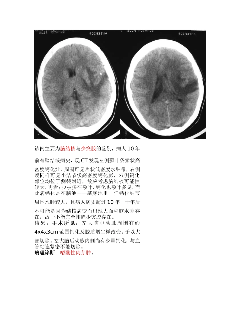 颅内嗜酸性肉芽肿一例_第2页
