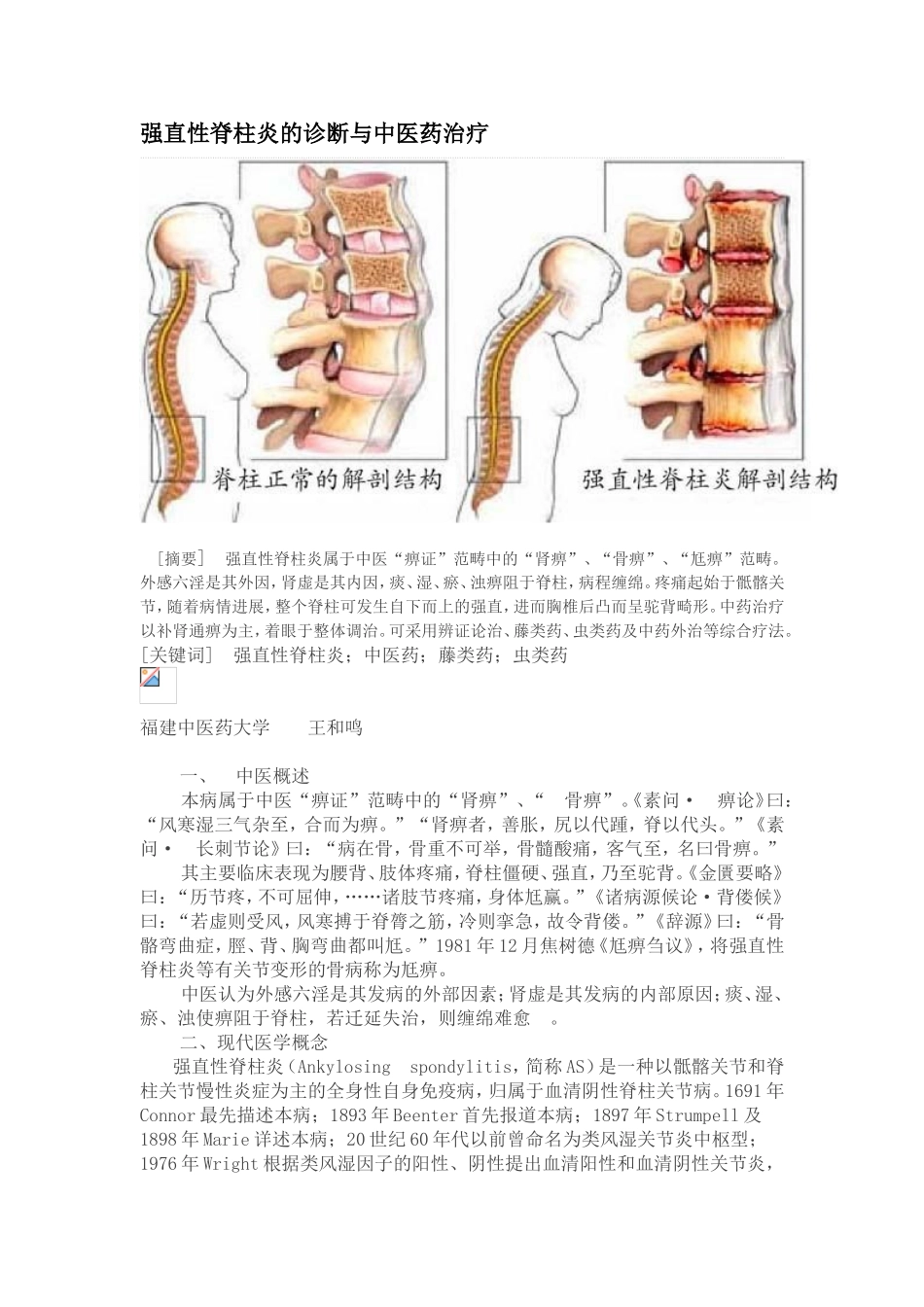 强直性脊柱炎的诊断与中医药治疗方法_第1页
