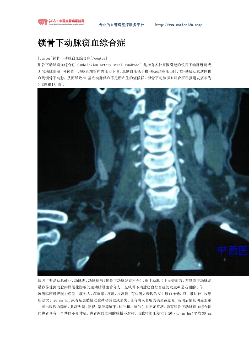 锁骨下动脉窃血综合症全程介绍_第1页