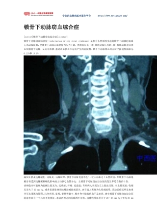 锁骨下动脉窃血综合症全程介绍