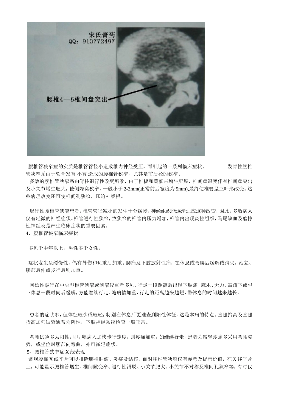 什么是腰椎管狭窄症_第2页