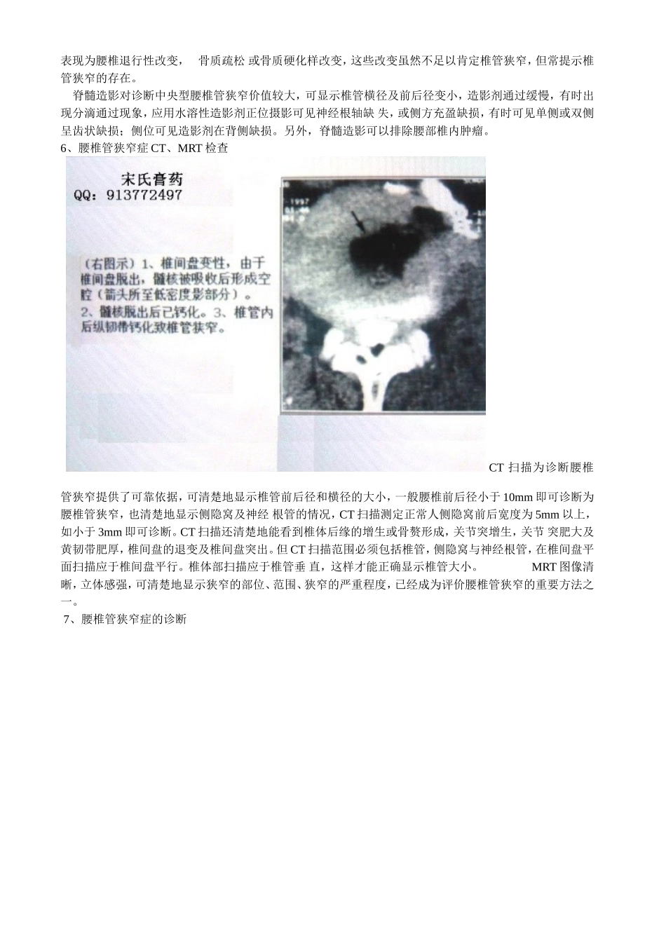 什么是腰椎管狭窄症_第3页