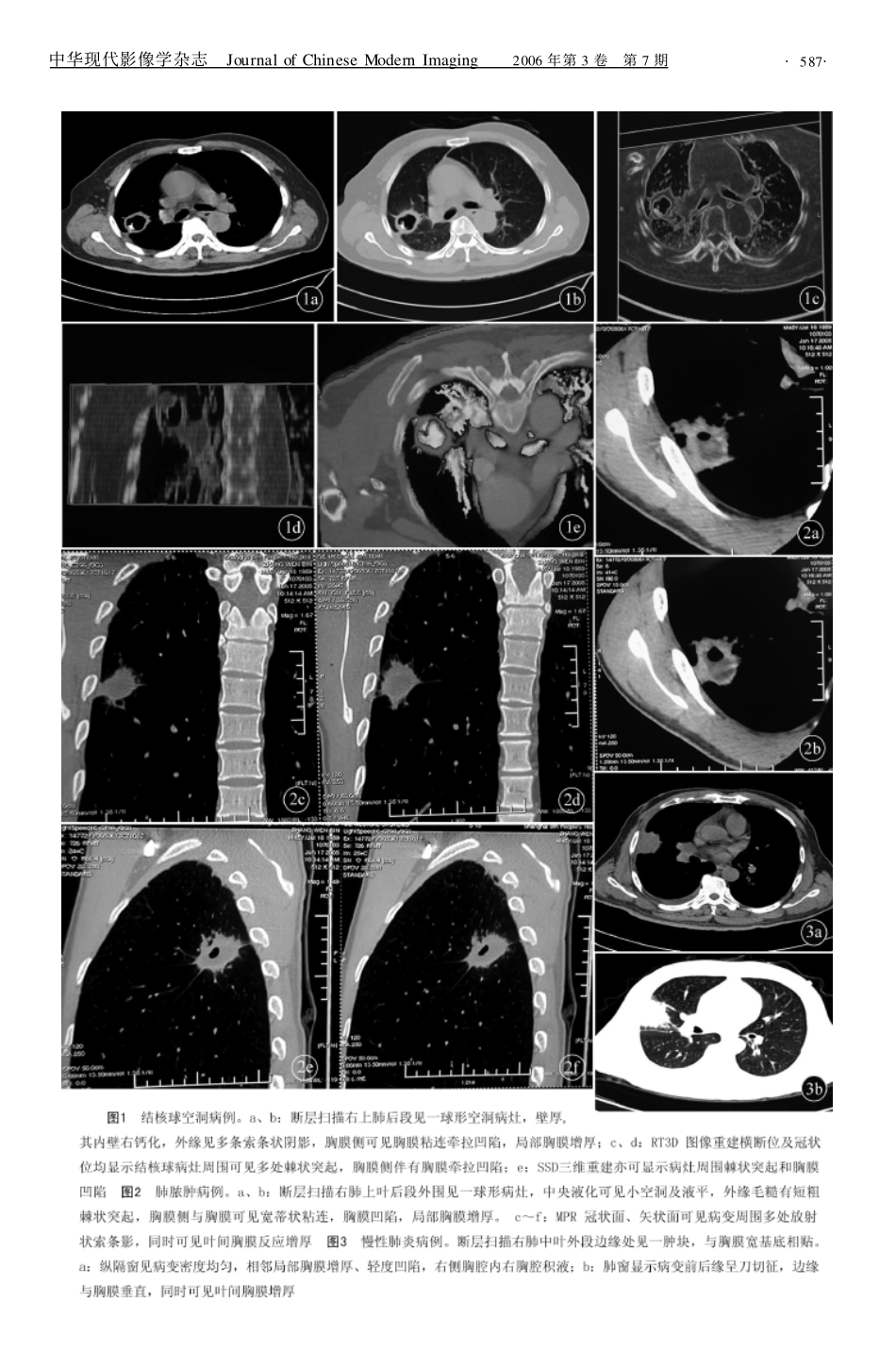 良性胸膜凹陷的CT诊断_第2页