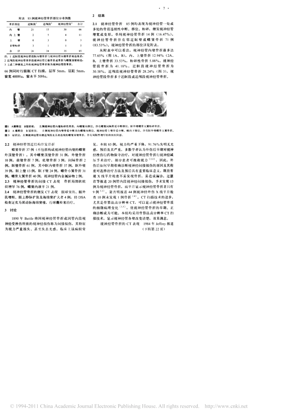 视神经管骨折的CT诊断_第2页