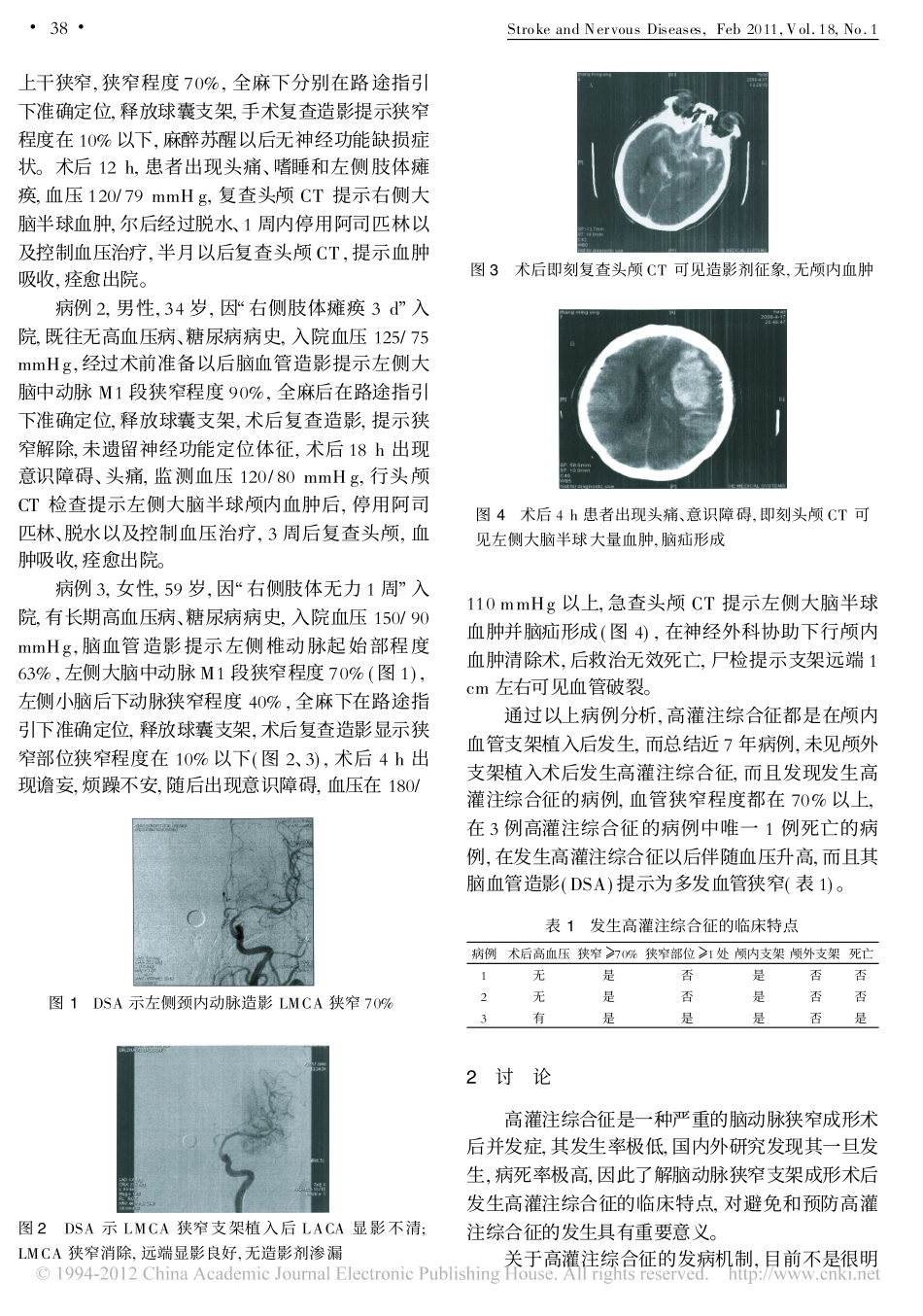 脑动脉狭窄支架成形术后高灌注综合征的临床特点分析_第2页
