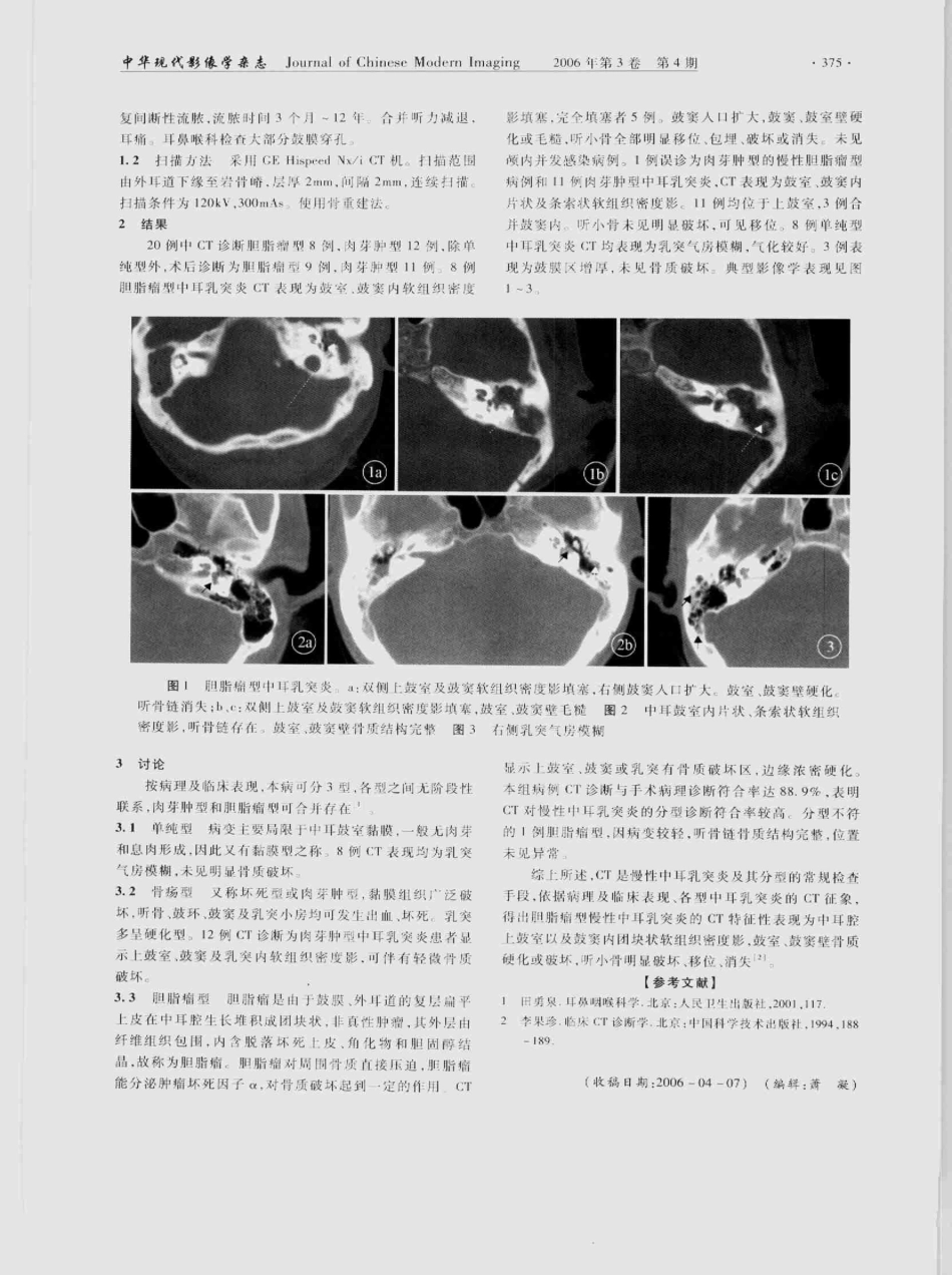 慢性中耳乳突炎的CT诊断_第3页
