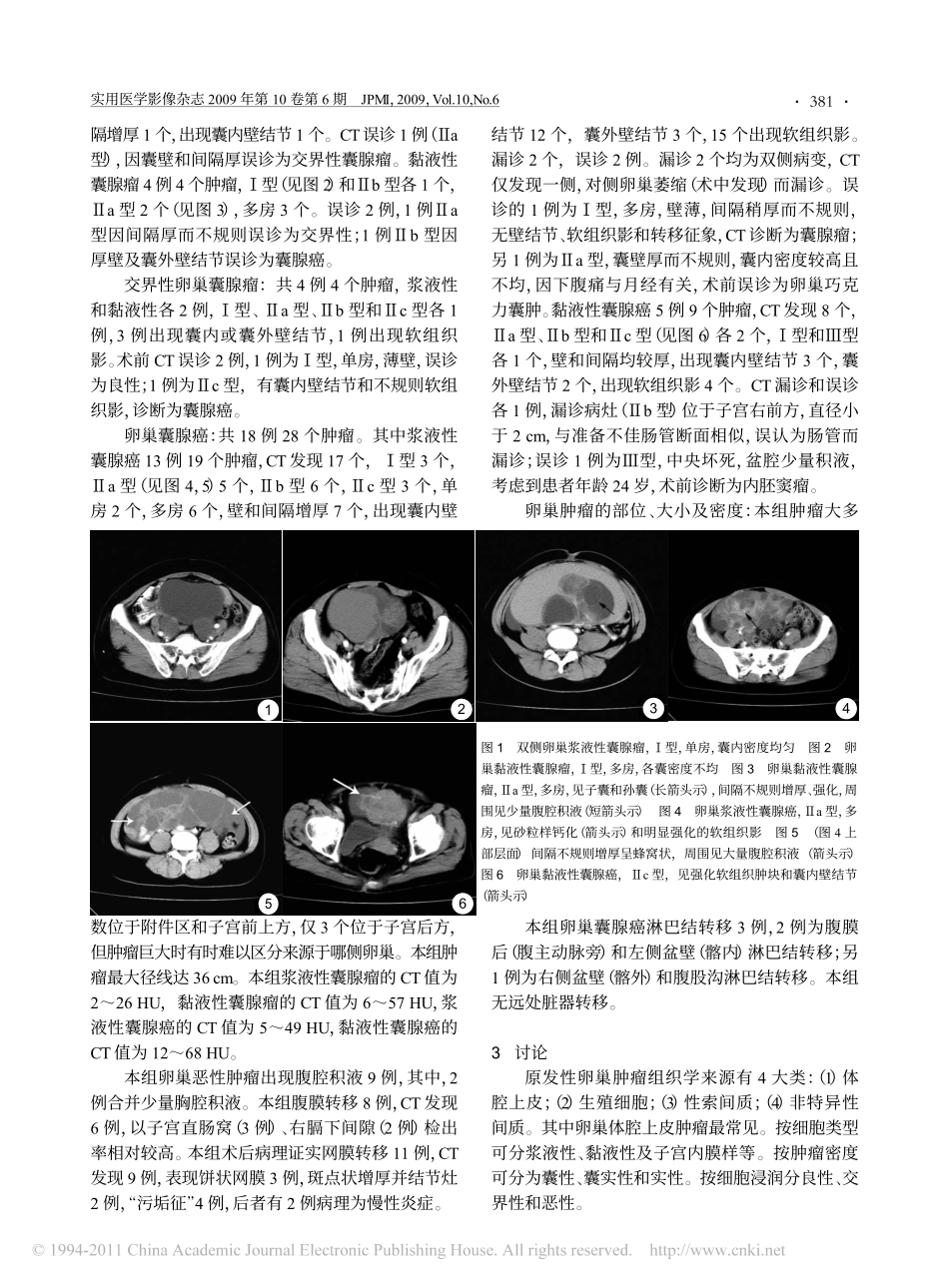 卵巢囊腺瘤与囊腺癌的CT诊断_第2页