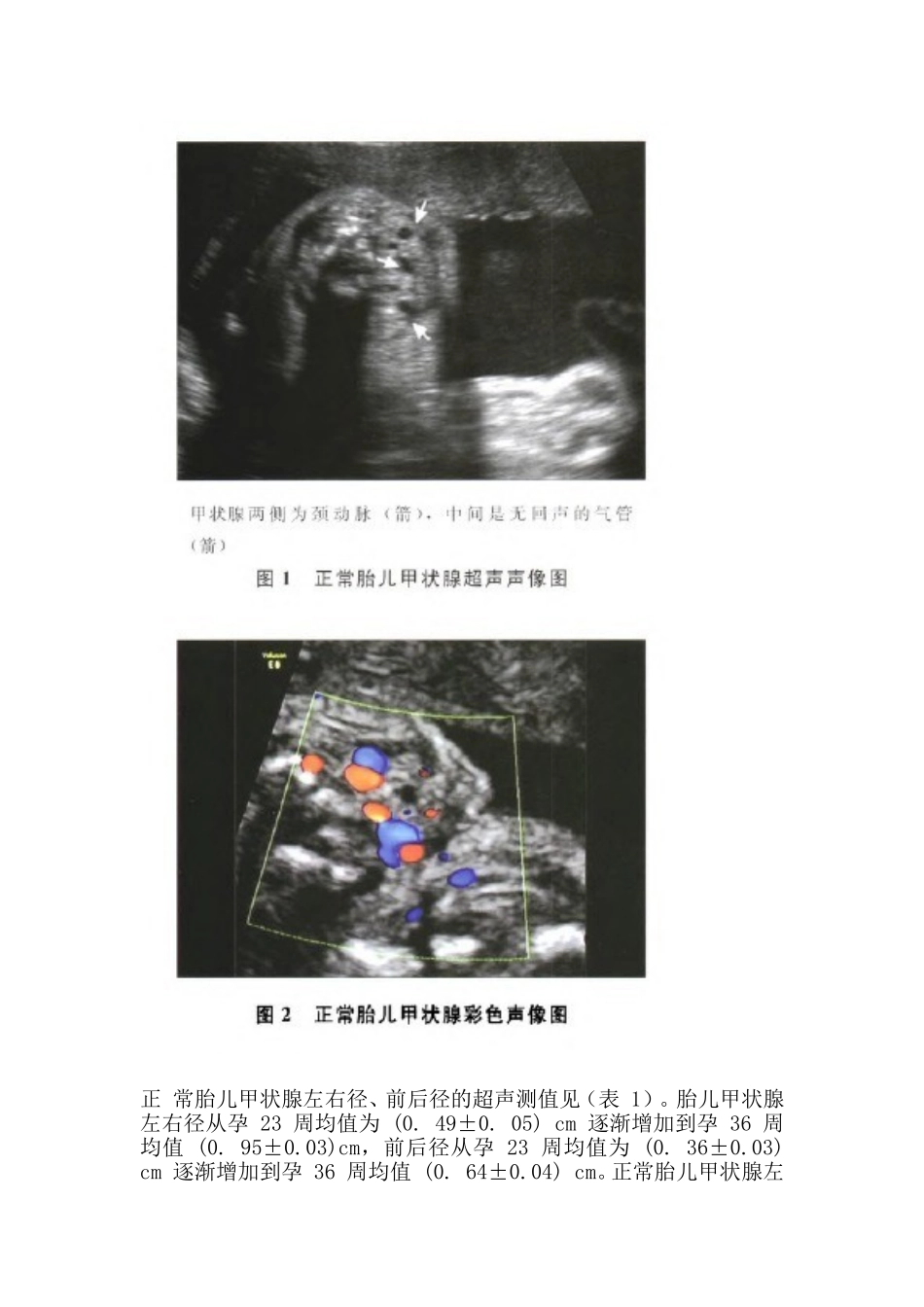 胎儿甲状腺的超声检测及其临床意义_第2页