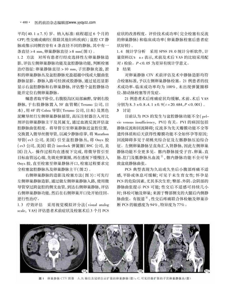 慢性盆腔淤积综合征的腔内栓塞治疗_郭平凡_第2页