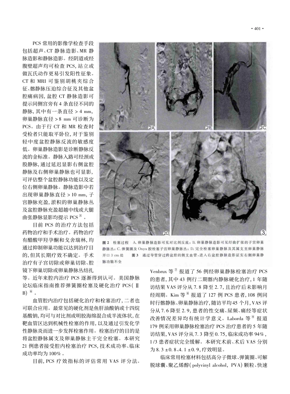 慢性盆腔淤积综合征的腔内栓塞治疗_郭平凡_第3页