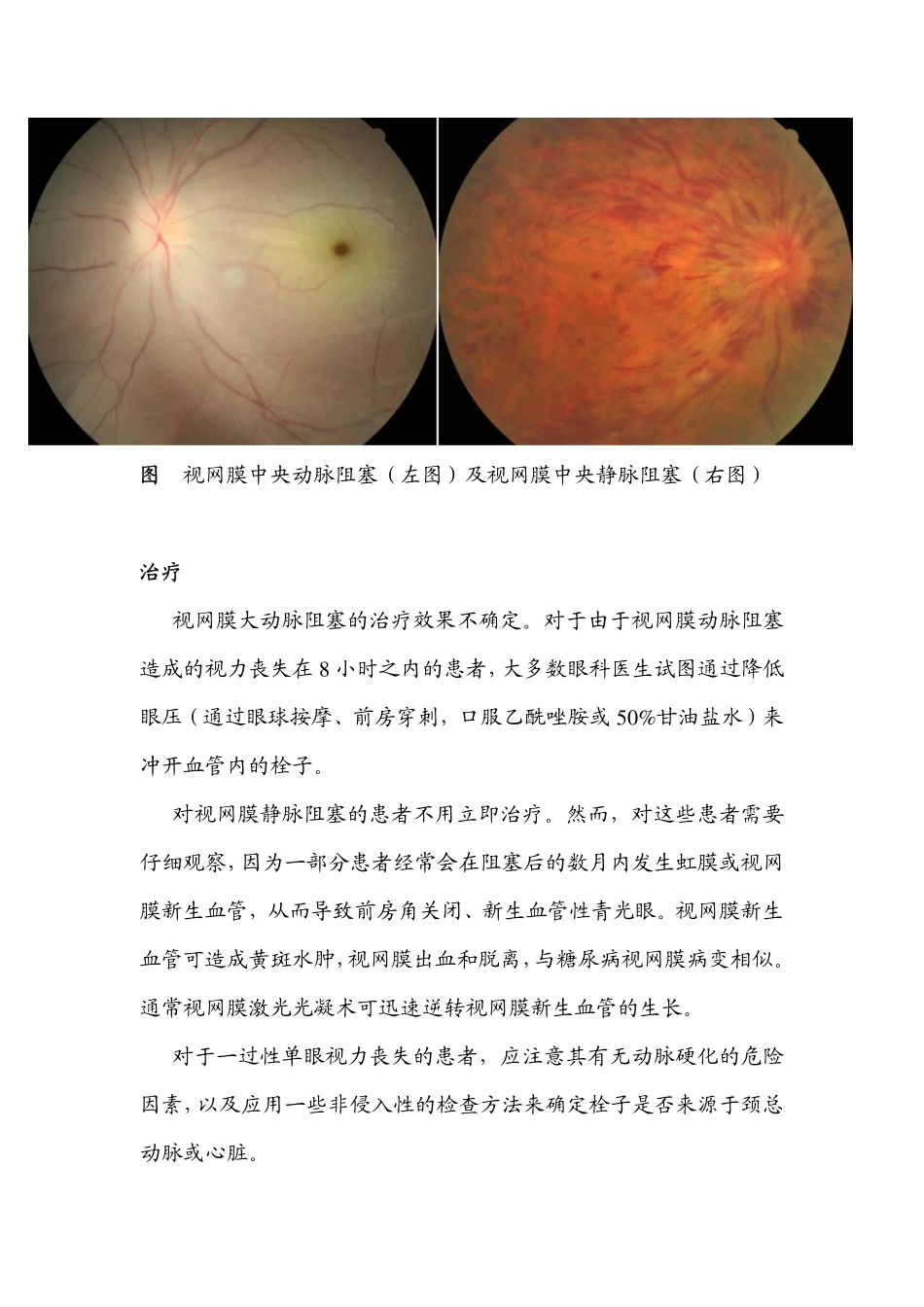 视网膜血管阻塞_第3页