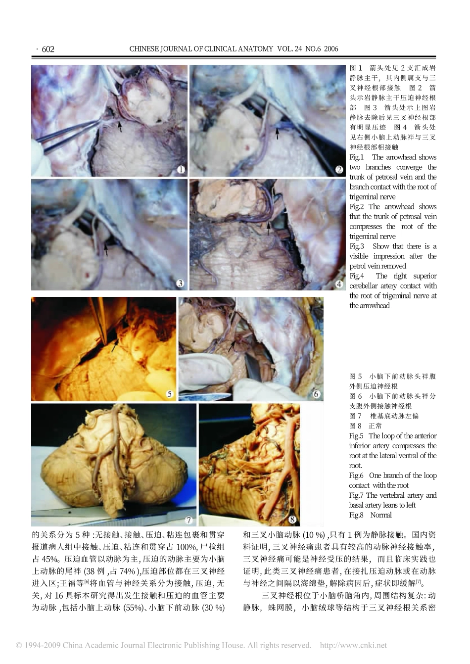 三叉神经根与周围血管关系及其临床意义_第3页