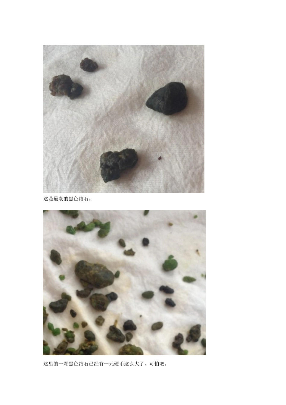 排除肝胆结石方法_第3页