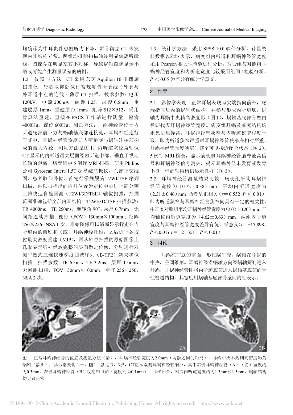 内听道狭窄合并耳蜗神经管狭窄的影像学表现_第2页