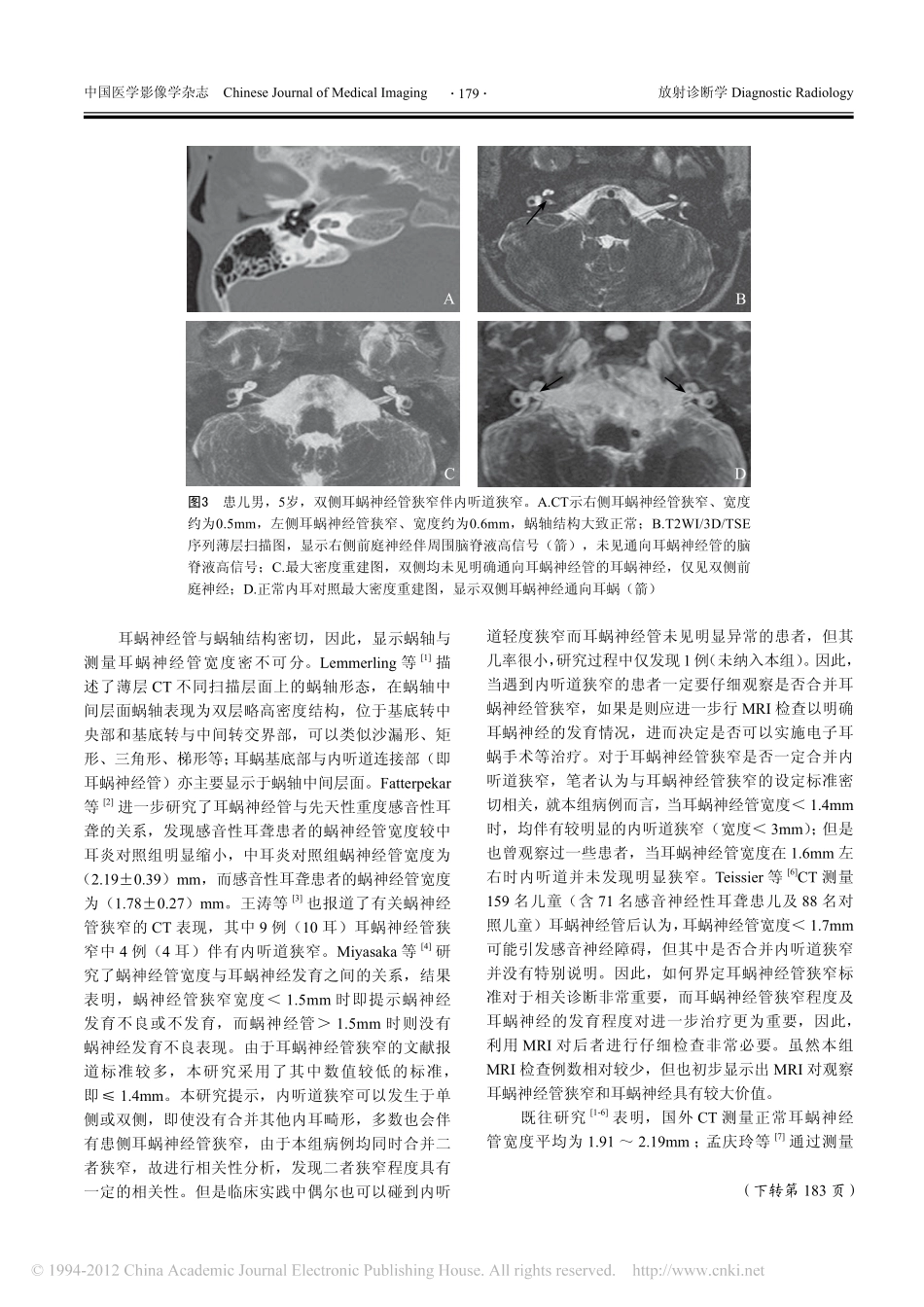 内听道狭窄合并耳蜗神经管狭窄的影像学表现_第3页
